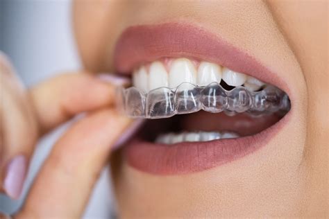 Invisalign.