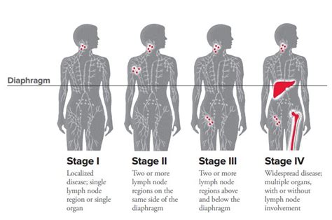 https://www.lls.org/lymphoma/hodgkin.